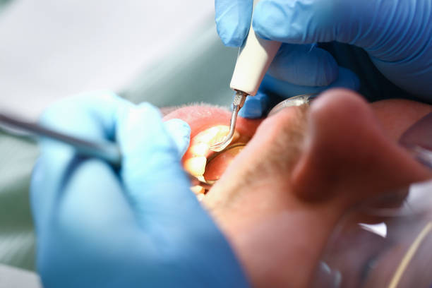Best Knocked-Out Tooth (Avulsed Tooth) Treatment in Ellisville, MS