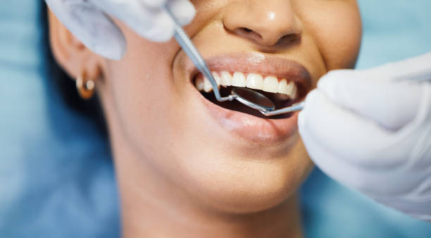 Best Emergency Wisdom Tooth Extraction in Ellisville, MS